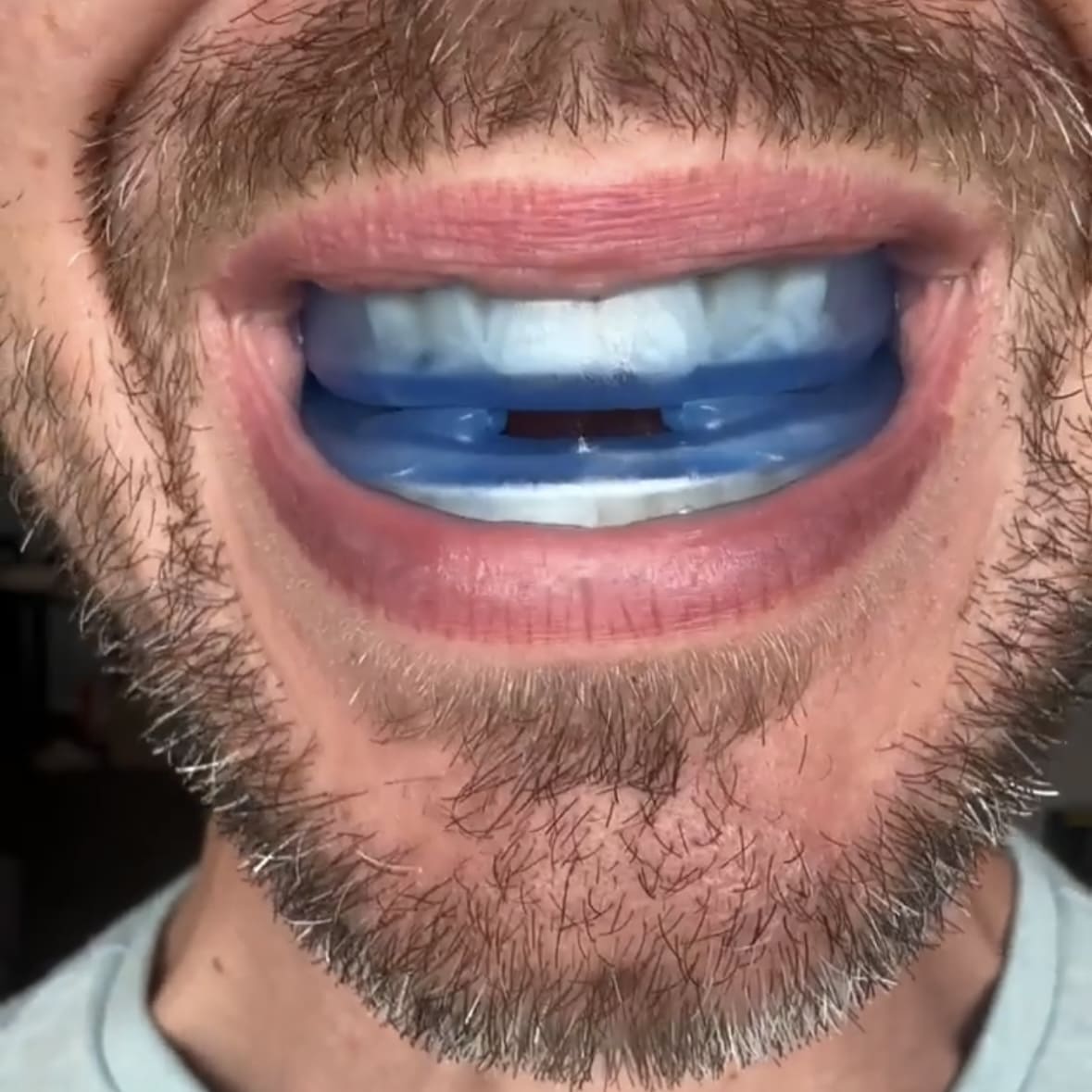 Anti-Snoring Mouth Guard